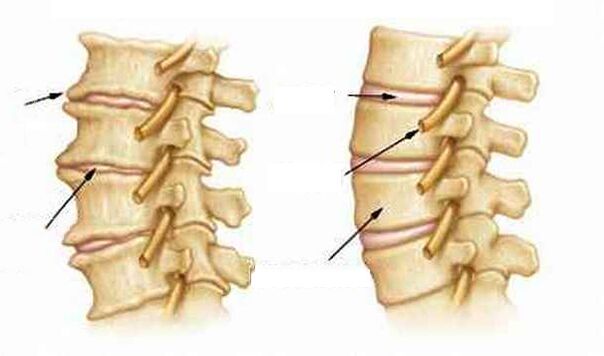 Mis on osteokondroos