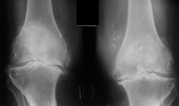 X -Ray kui viis põlveliigese artroosi diagnoosimiseks